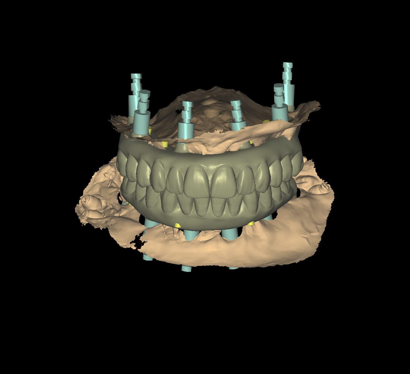 A photogrammetry capture: the scan bodies on the implants, registered to the arch