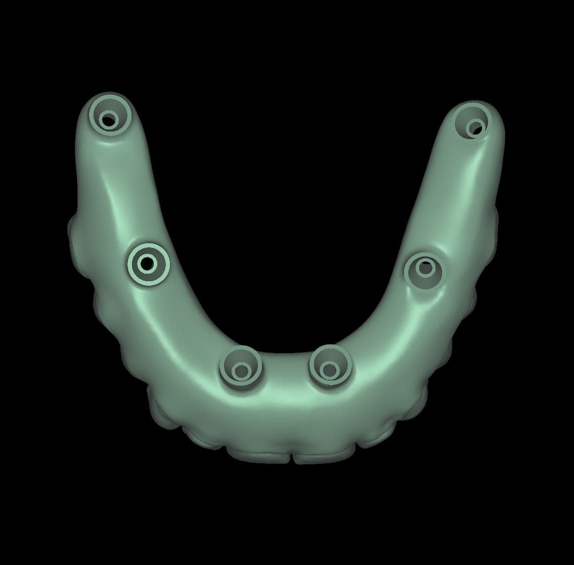 A Vertex surgery design: the arch with its implant positions and multi-unit abutments