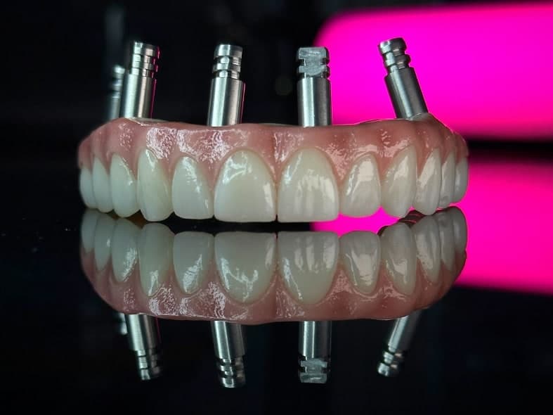 A finished upper All-on-X prosthesis with its multi-unit abutments in place, photographed under the pink light